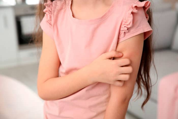 Dermatitis infantil