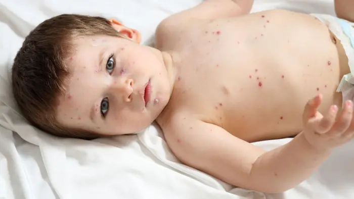 Enfermedades contagiosas en niños