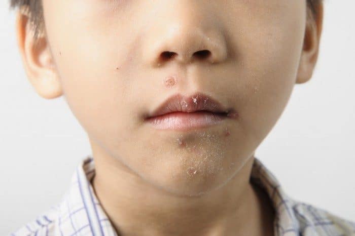 Todo Lo Que Debes Saber Sobre El Herpes Infantil