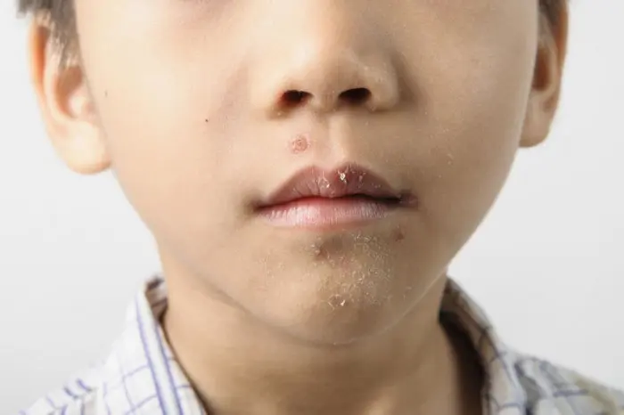 Herpes en niños: Lo que todo padre debe saber