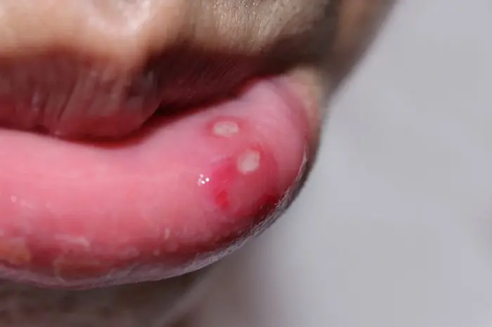 Herpes en niños