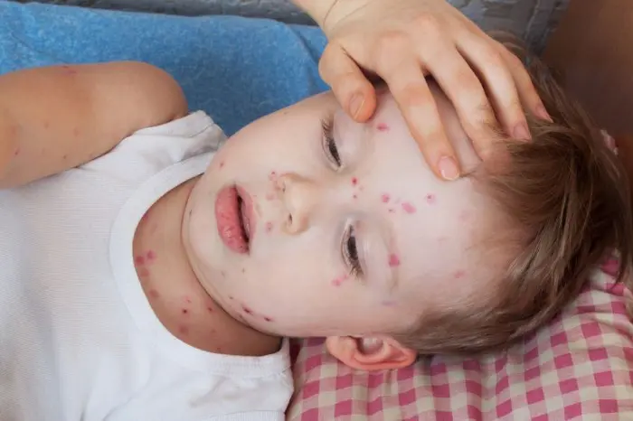 Varicela en niños: Síntomas, tratamiento y pronóstico