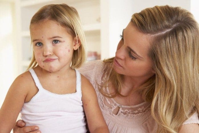 Sarampión en niños