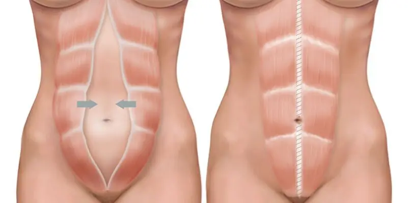 Diastasis abdominal