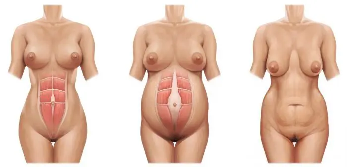 Diastasis abdominal sintomas y fotos reales