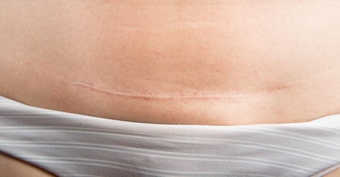 Cicatriz de cesárea