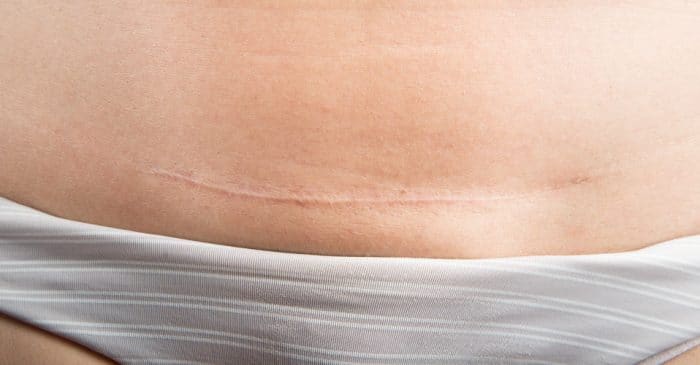 Cicatriz de cesárea Cicatriz de cesárea