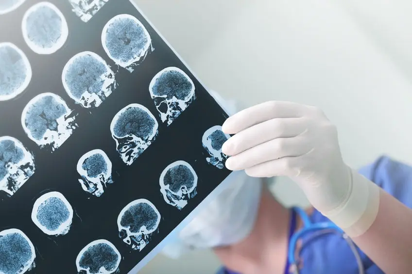 ¿Cómo actuar ante un ataque de epilepsia infantil?
