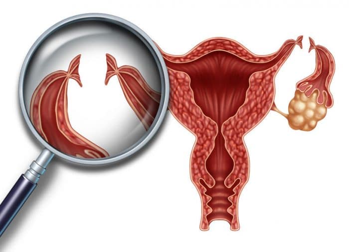 Revertir la ligadura de trompas Revertir la ligadura de trompas