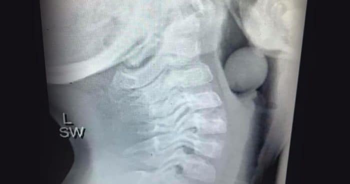 Radiografia nino atragantado uva