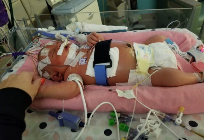 Mariana bebé muerto Meningitis HSV1 herpes labial