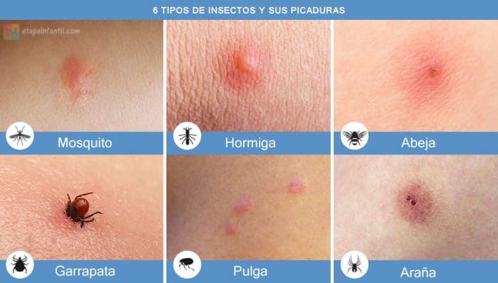 Tipos de picaduras de insectos para identificar con fotos Tipos de picaduras de insectos para identificar con fotos