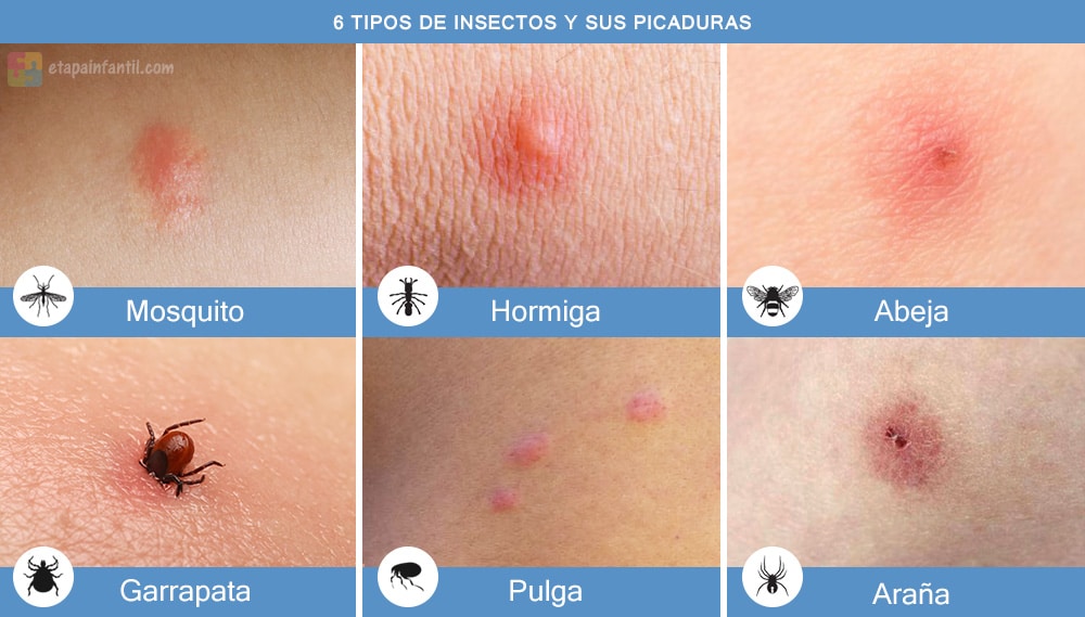 Tipos de picaduras de insectos.
