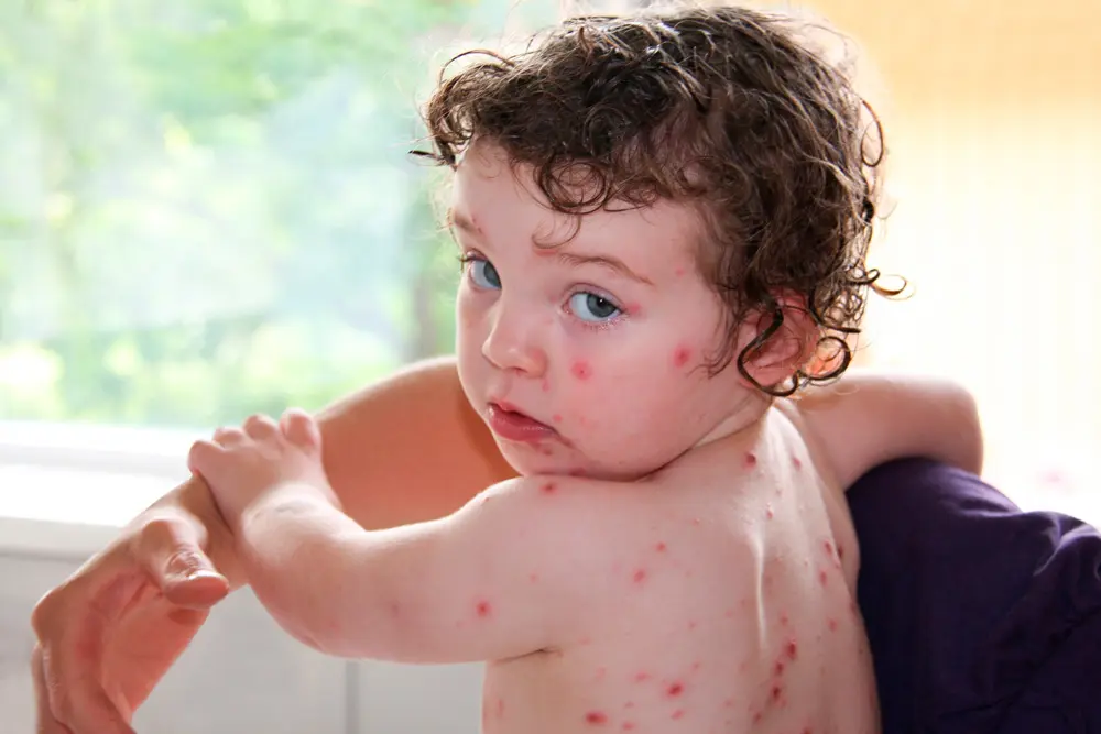 Bebé de 11 meses sufre derrame cerebral a causa de una varicela