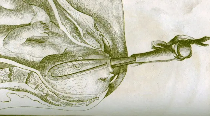 obstetricia siglo XVIII