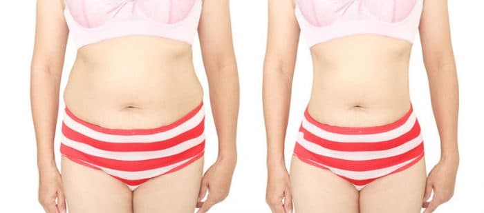 barriga flacida despues del parto