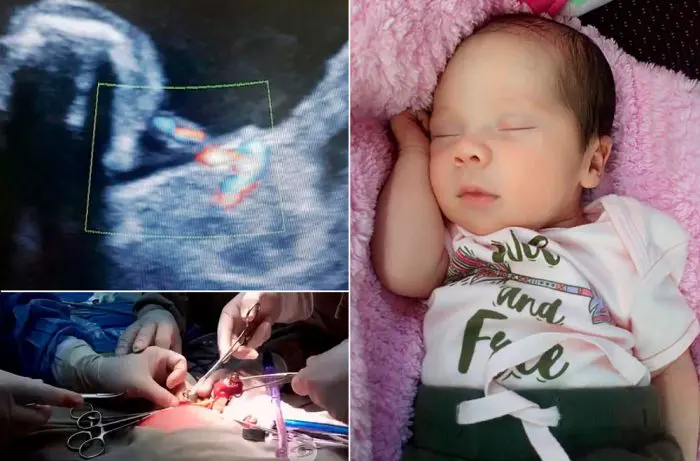 itzamara fetus in fetus