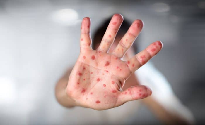 muertos sarampion movimiento antivacunas