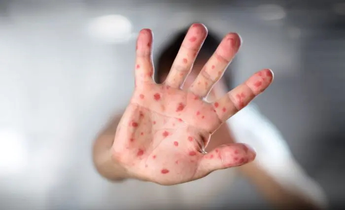 muertos sarampion movimiento antivacunas