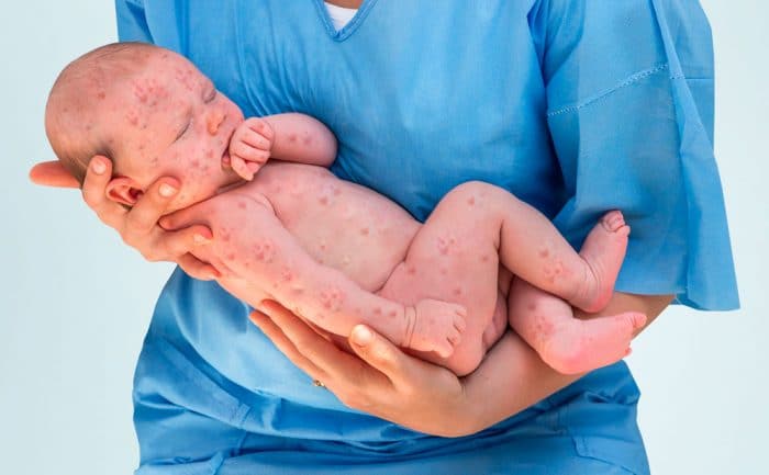Sarampión antivacunas