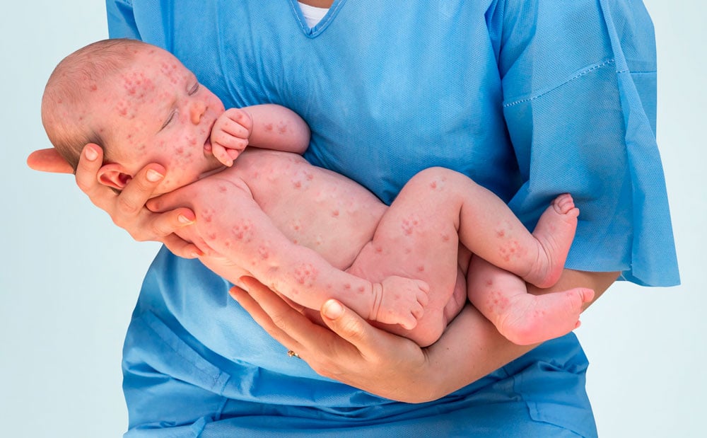 Sarampión antivacunas