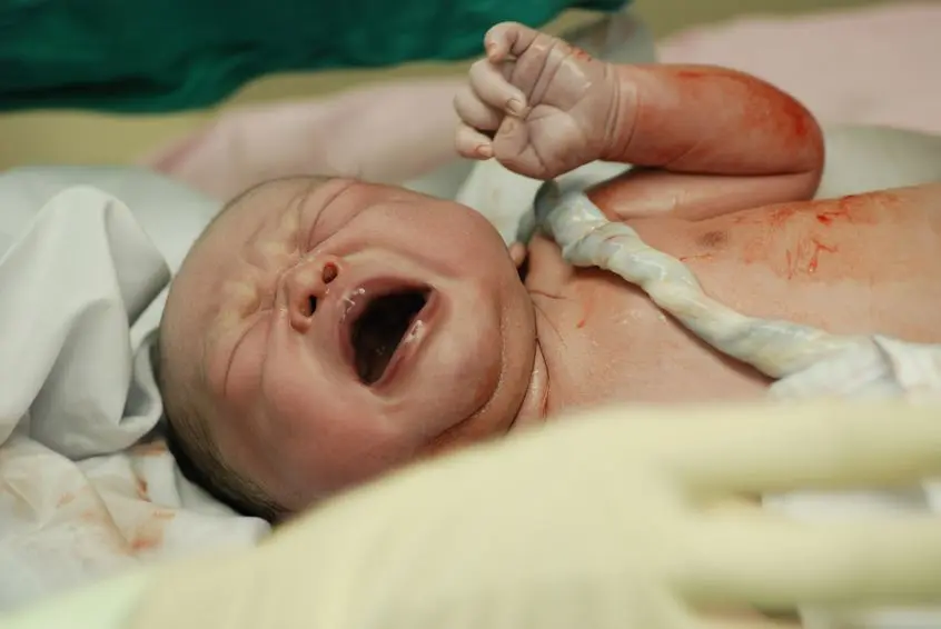 Circular de cordón: Cuando el cordón se enrolla alrededor del cuello del bebé
