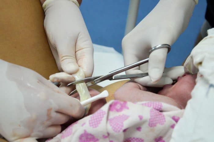 Circular De Cordon Cuando El Cordon Se Enrolla Alrededor Del Cuello Del Bebe Etapa Infantil Circular De Cordon Cuando El Cordon Se Enrolla Alrededor Del Cuello Del Bebe Etapa Infantil