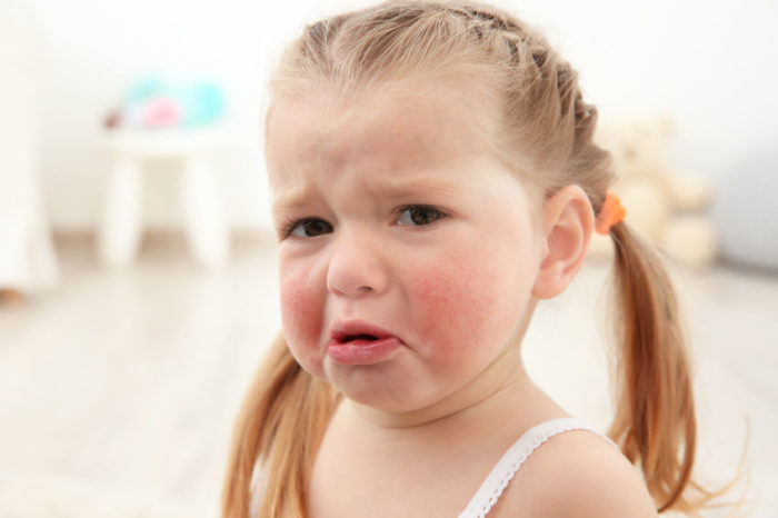 síntomas alergia marisco niños