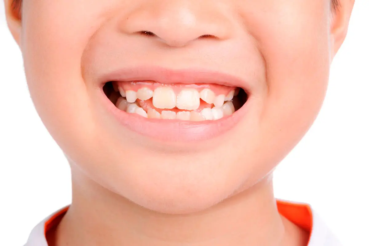 Manchas y decoloración en los dientes de los niños