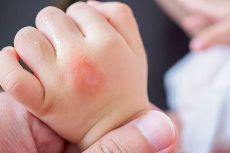 Picaduras de pulgas en niños: Todo lo que debes saber